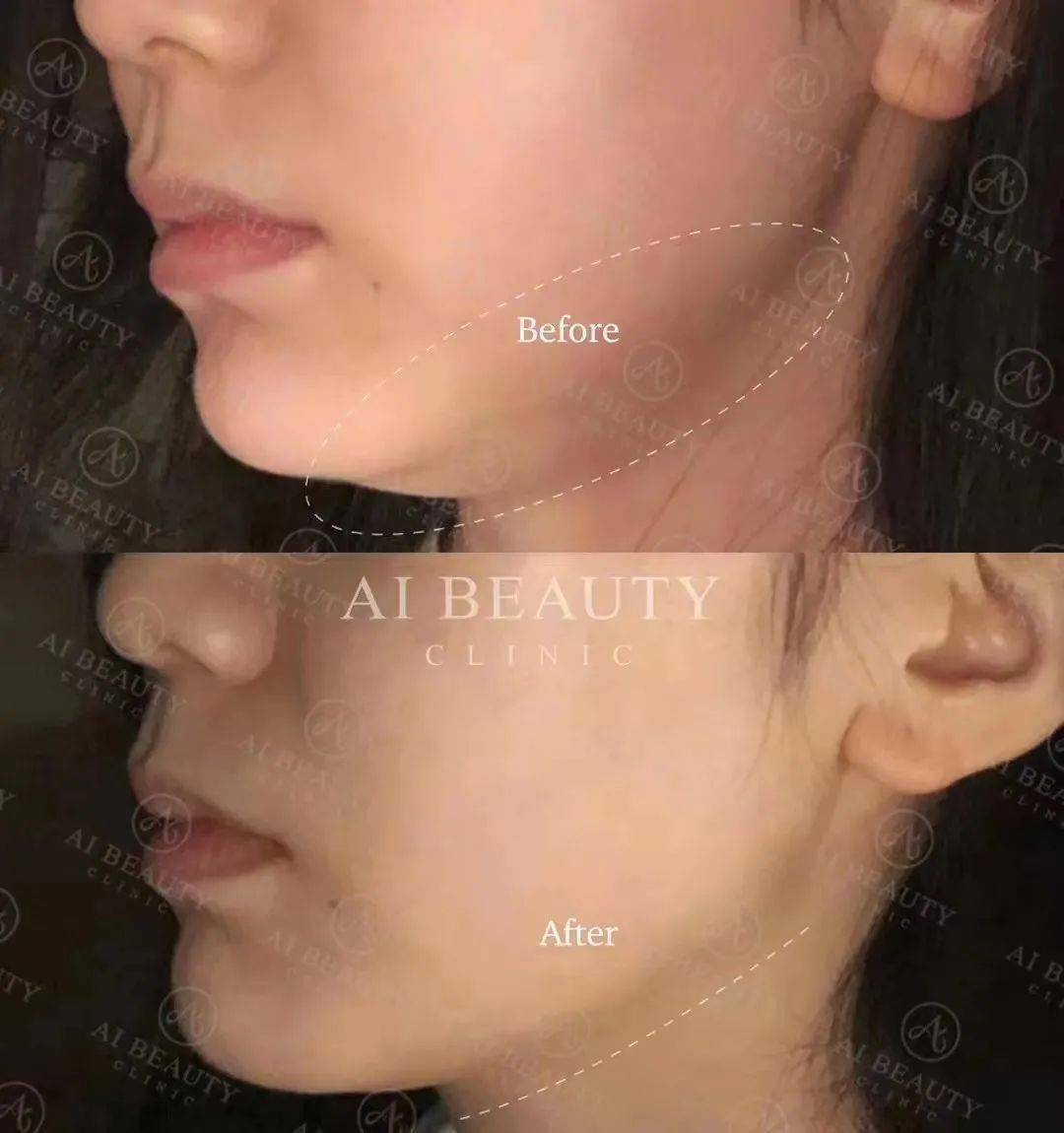 但是溶脂针可以!大腿都是脂肪的大象腿可以打溶脂针!