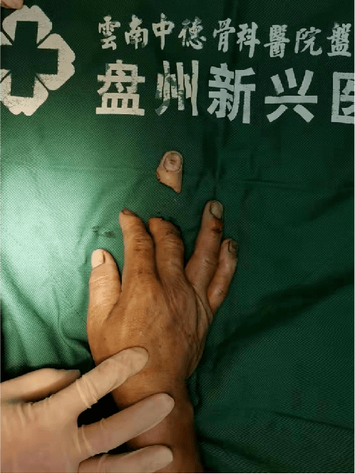 断指重生,盘州这家医院不简单_患者_断肢_血管