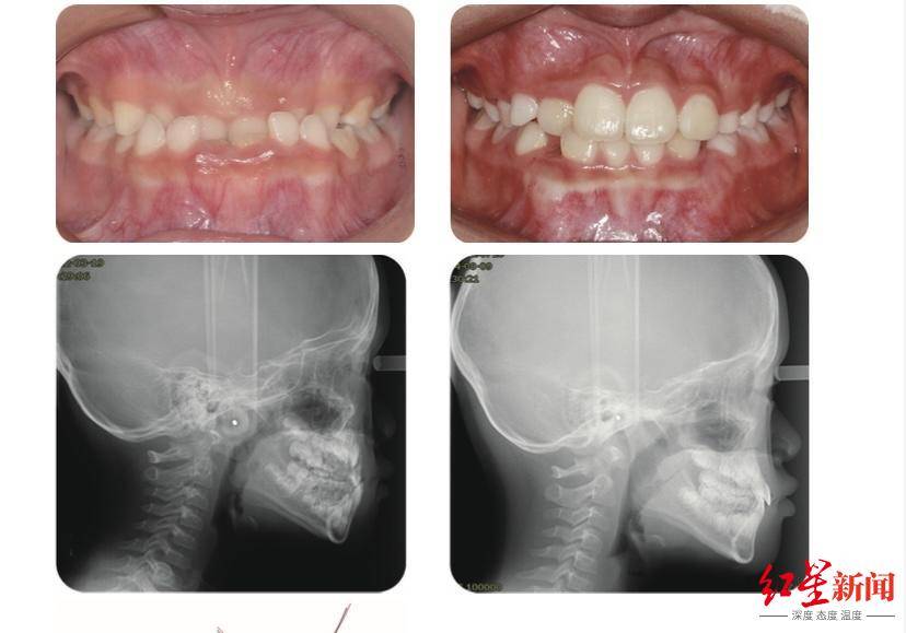 6亿儿童 华西口腔医院专家:三大因素造成,早期矫治可