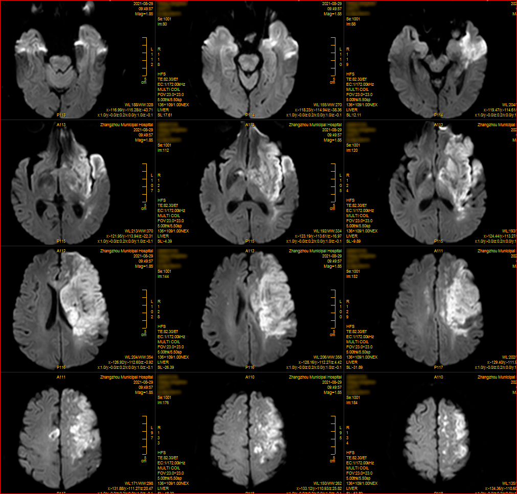 陈文伙教授团队专栏丨术前多时相cta影像评估指导t字部双支架取栓1例