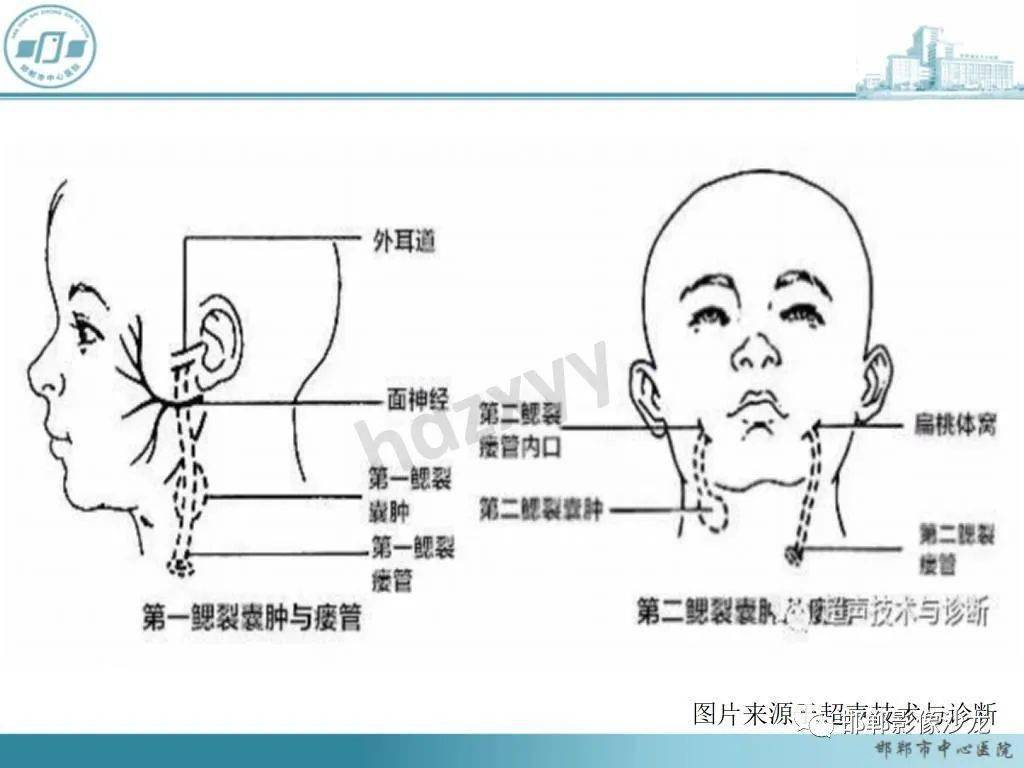 第三鳃裂瘘管图片图片