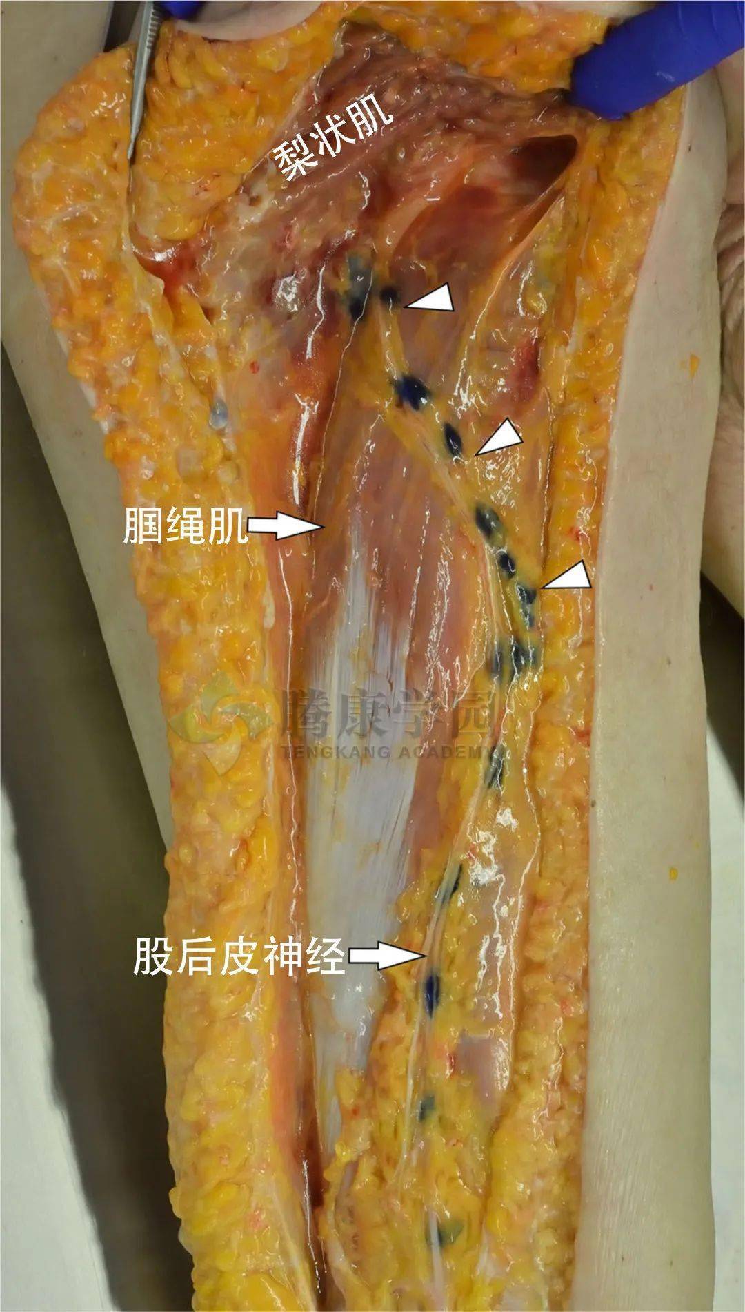 大腿后部疼痛的神经