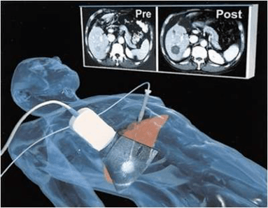 在肝实质内肝静脉与门静脉间建立起人工分流通道,并以金属支架维持