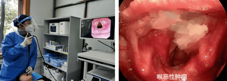 由于喉癌早期误诊率较高,因为喉癌初期仅有喉部不适,声音嘶哑等症状