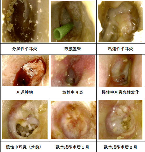 耳鼻喉科更新检查治疗镜医疗检测能力提档升级