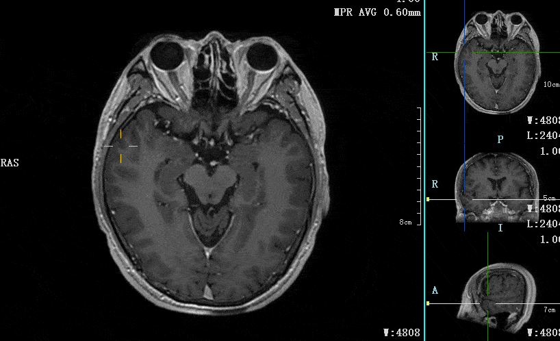 海马区CT解剖图片