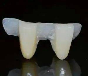详解马里兰桥,你真的掌握了吗?_牙齿_预备_金刚砂