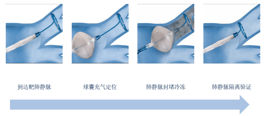 首例!我院成功开展房颤冷冻球囊导管消融术