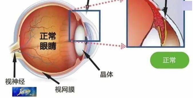 祝您健康||別讓青光眼偷走你的視力!_眼壓_患者_視野