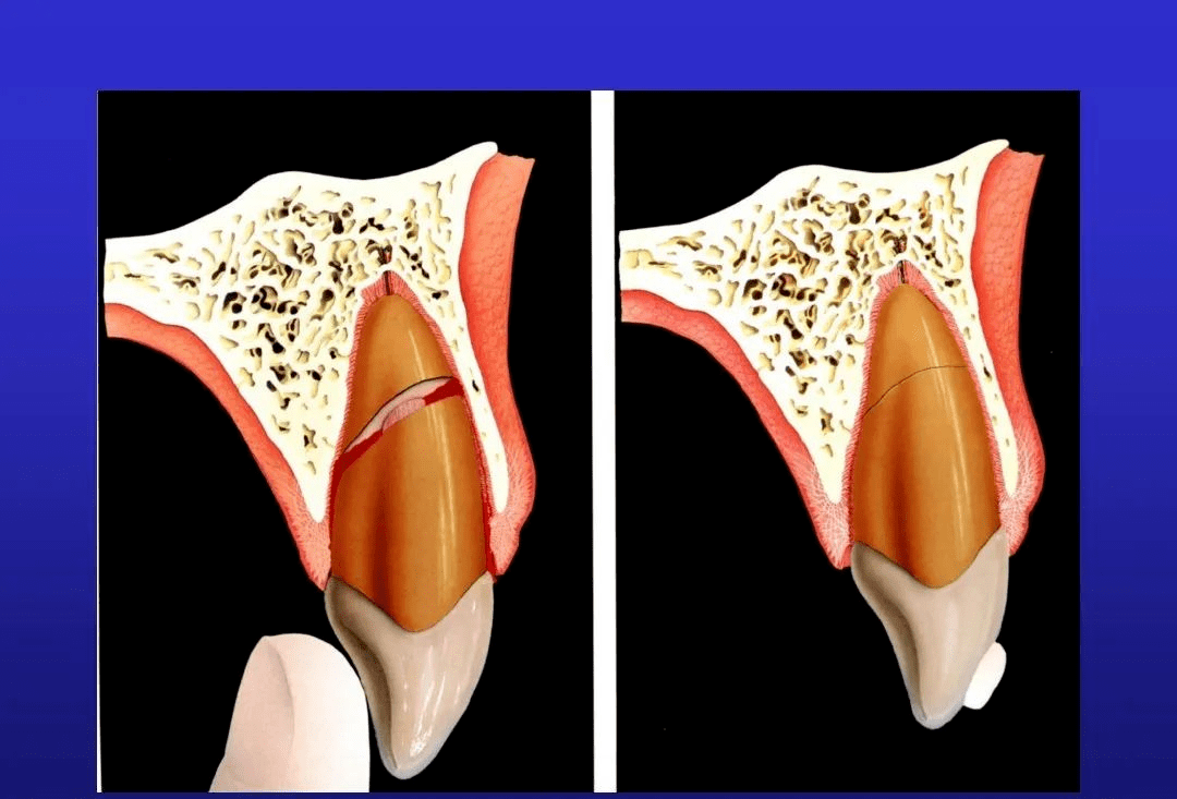 牙折的病因及治疗方法