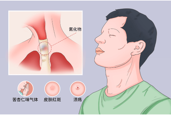 氰化物中毒该怎么处置