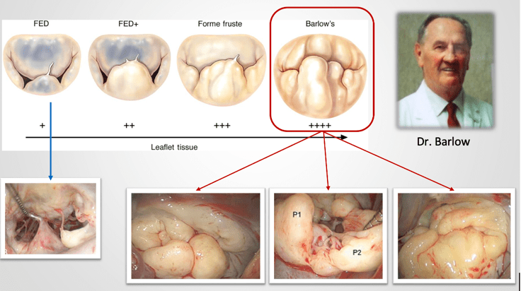 cci创新快讯可以导致猝死的良性疾病对barlow综合征二尖瓣脱垂综合征