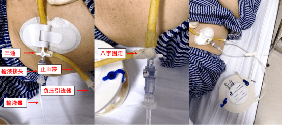 简易负压腹腔引流装置可以在原有一根腹引的基础上完成持续腹腔冲洗