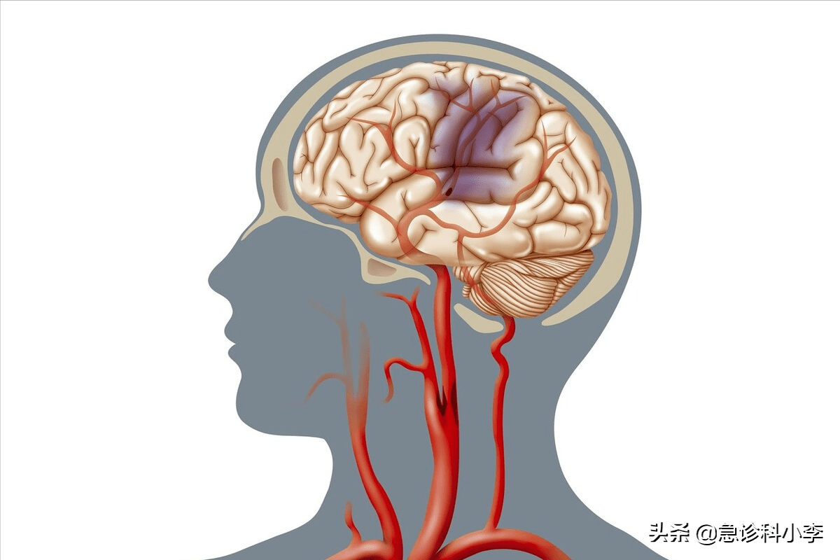 50岁男子深夜脑梗瘫痪,医生提醒:中老年人晚饭后,要少做3件事_赵先生_