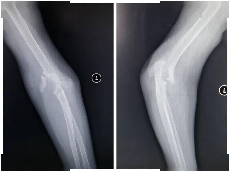 68岁女士67骨质疏松严重轻微撞伤竟导致67