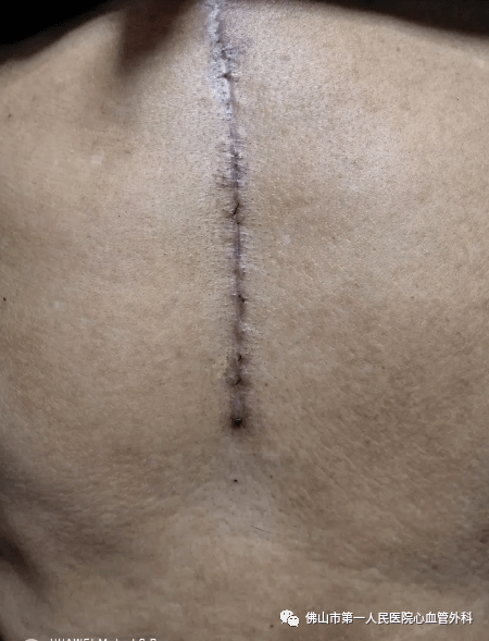 胸腔手术疤痕图片图片