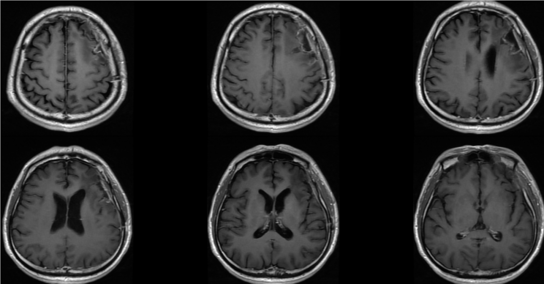 愛見新生一例膠質母細胞瘤患者who4級術後tmz聯合ttfields治療總生存