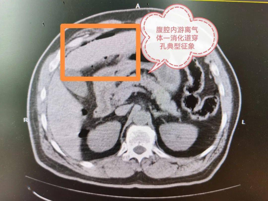 胃穿孔x光图片图片