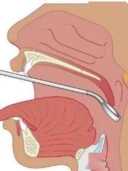 異物_食道_喉鏡