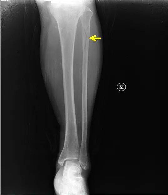 胫腓骨双骨折胫骨结节撕脱性骨折髌骨骨折右侧胫骨平台骨折右侧股骨下