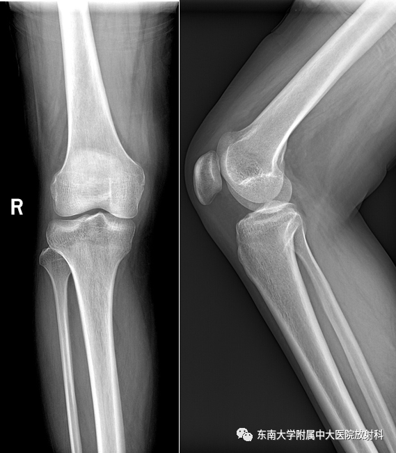 骨梗死影像表现