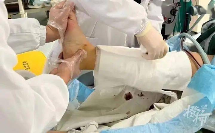 与老公闹矛盾她借酒消愁盘坐10多个小时家人发现时全身冰冷差点被截肢