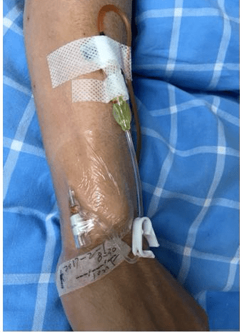 静脉穿刺困难两根压脉带法究竟应该怎么做