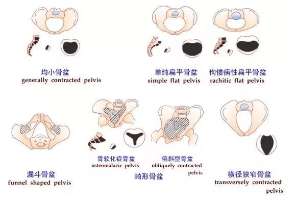 常见狭窄骨盆①均小骨盆骨盆各径线均比正常值短2cm以上