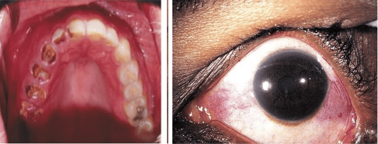 干燥综合征——最常见,最容易忽视的风湿病_诊断_免疫_检查