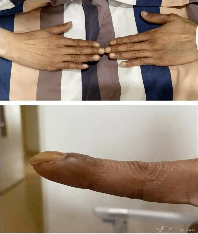 如此标准的「杵状指」,心衰病因扑朔迷离._pg_病史_患者