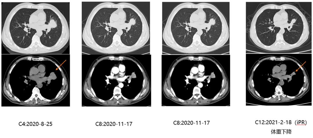 肺癌是全球死亡率最高的惡性腫瘤,非小細胞肺癌(nsclc)是其最常見的