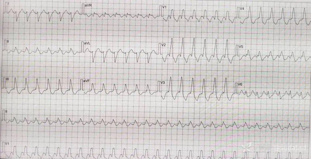 酷似室速的心电图图片