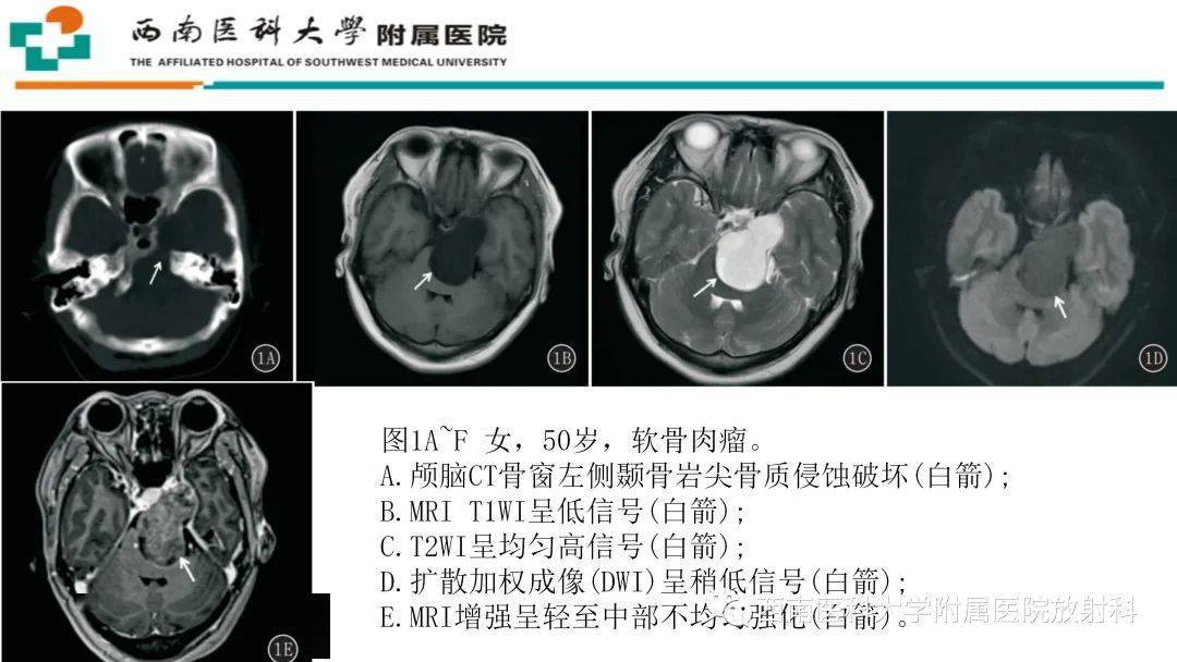 脊索瘤图片及讲解图片