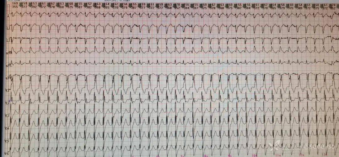 8份真假分支型室速心电图你能正确识别吗