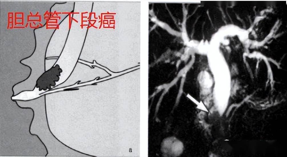 深刻理解壶腹周围癌不是壶腹部癌