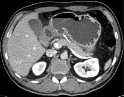 急性胃痛影像表现