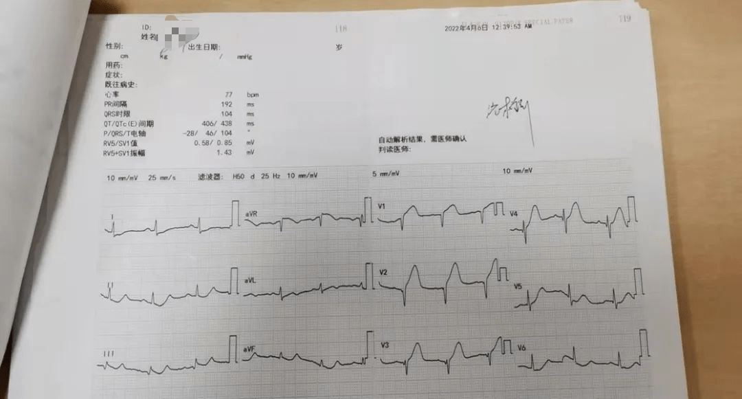 stemi溶栓61经典病例急性前壁st段抬高心梗溶栓病例分享