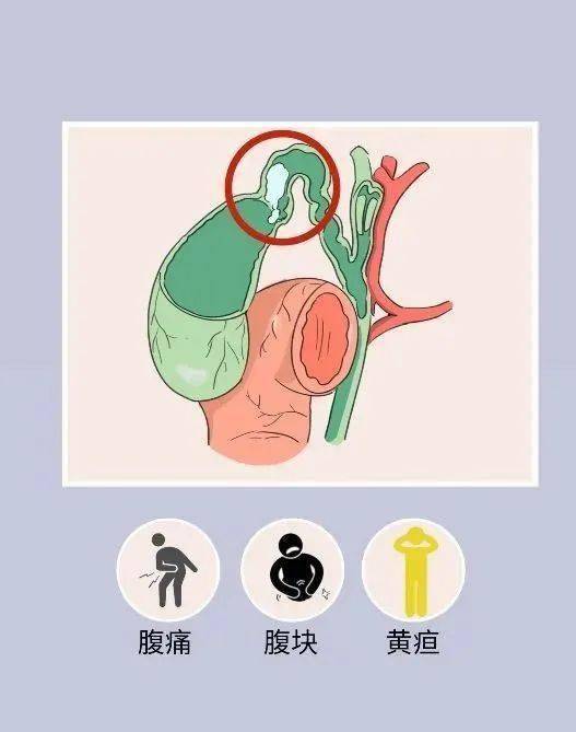 "不声不响"的胆结石_胆囊_患者_症状