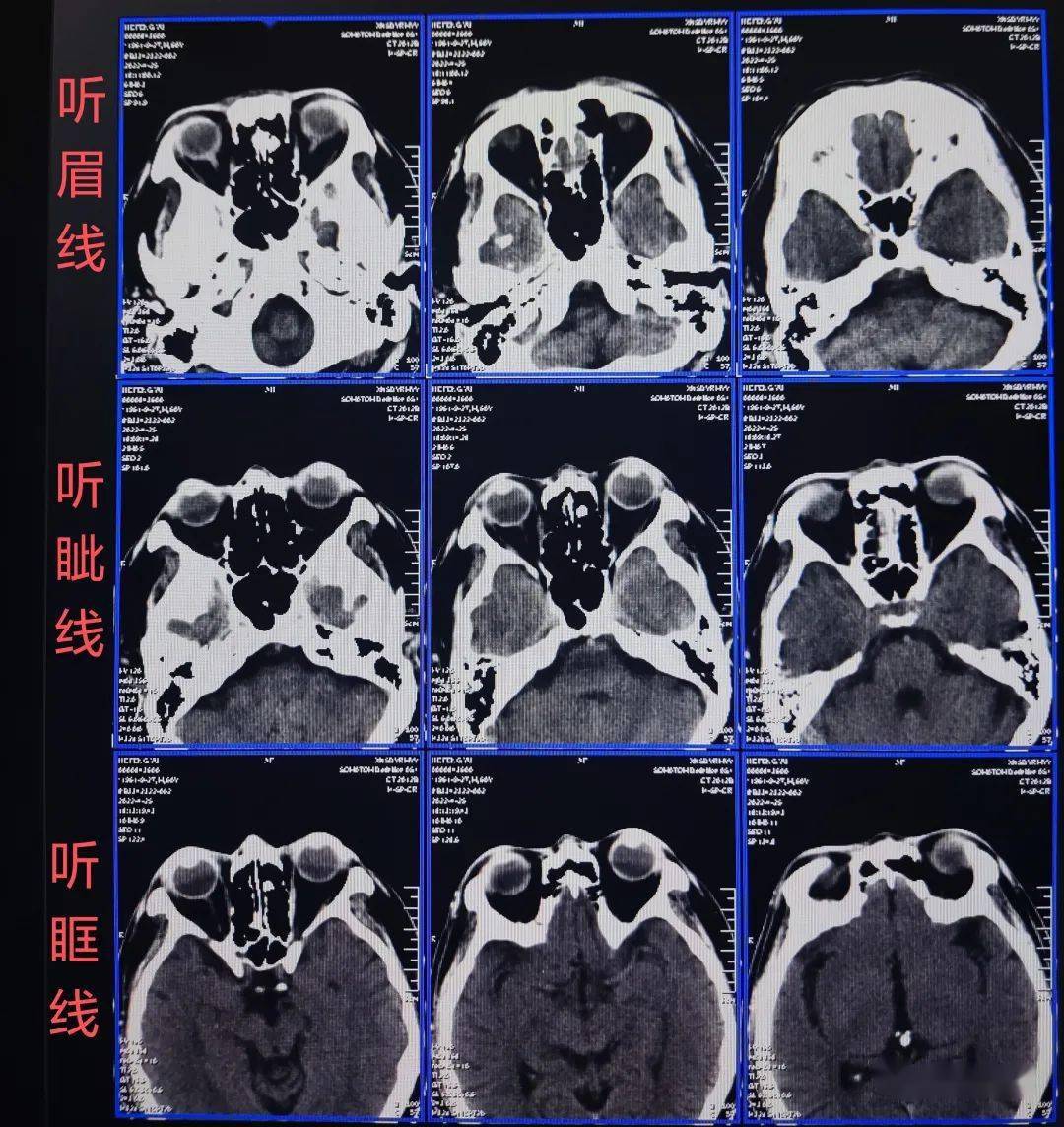 ct头颅扫描定位线图片图片