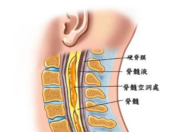 這些解剖結構決定了脊髓和神經根容易受壓而出現各種各樣神經根性症狀