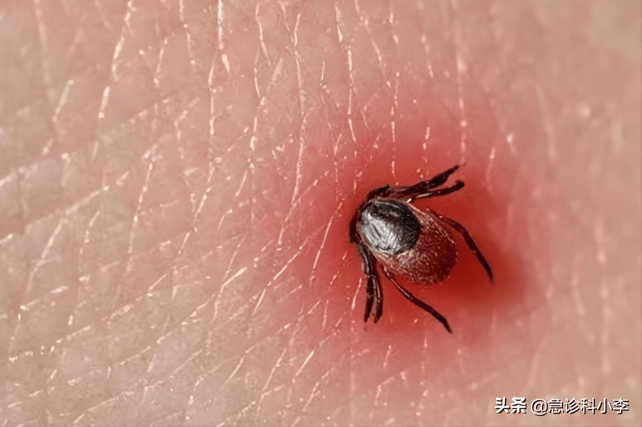 夺命蜱虫钻人体内吸血已经致多人死亡被咬后应该怎么处理