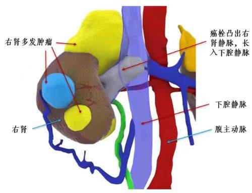 下腔静脉b超的解剖图图片