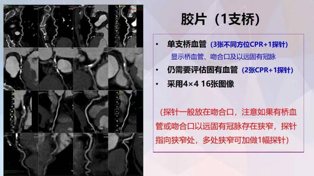 冠脉及胸痛三联cta重建规范及报告模板