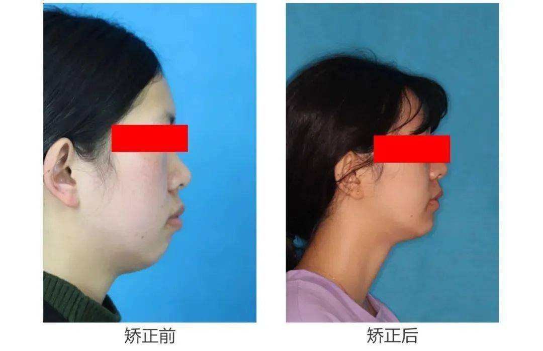 重磅 招募千人半价矫正牙齿 牙不齐的速看 矫牙 面型 口腔