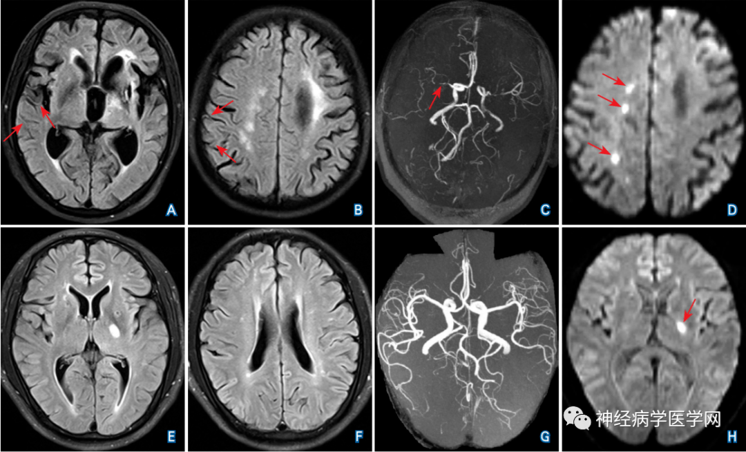 flair血管高信号征的定义影像表现原理及临床应用