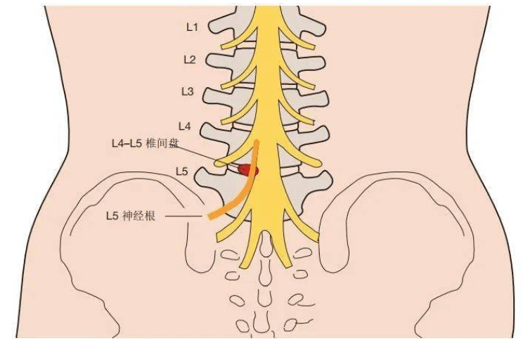 l4椎体位置图图片