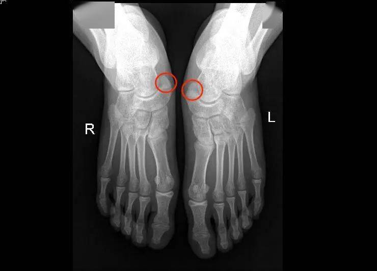 脚面骨的位置图图片