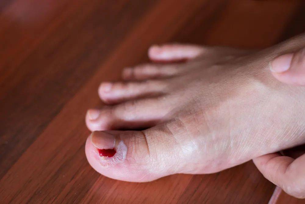 嵌甲,甲沟炎,灰指甲,指甲的小毛病一次说清_治疗_医生_诊断