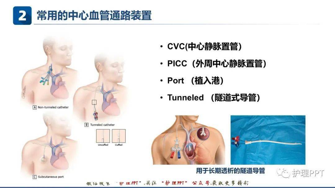 【ppt】中心静脉血管通路的选择