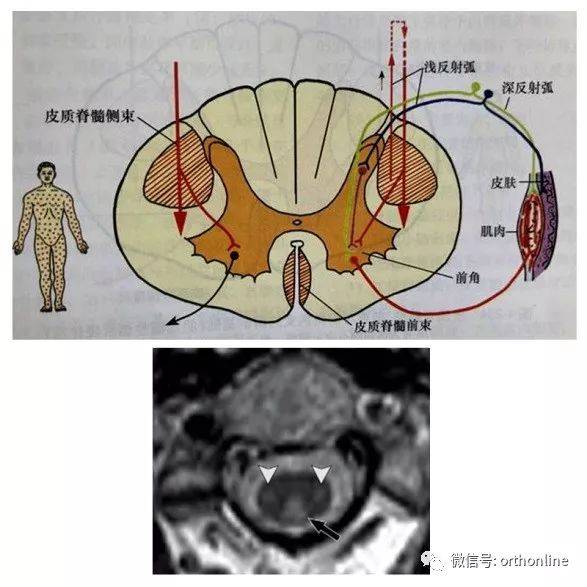 皮質脊髓束受損病變皮質脊髓束按胸,腰,骶由內向外排列,脊髓前角運動